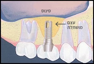 הרמות סינוס