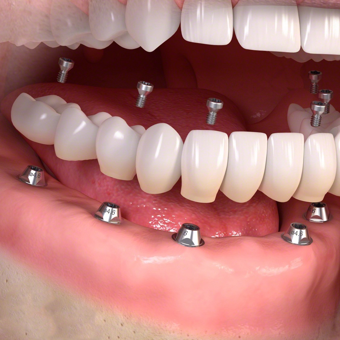 שיקום שיניים בשיטת All-0n-6
