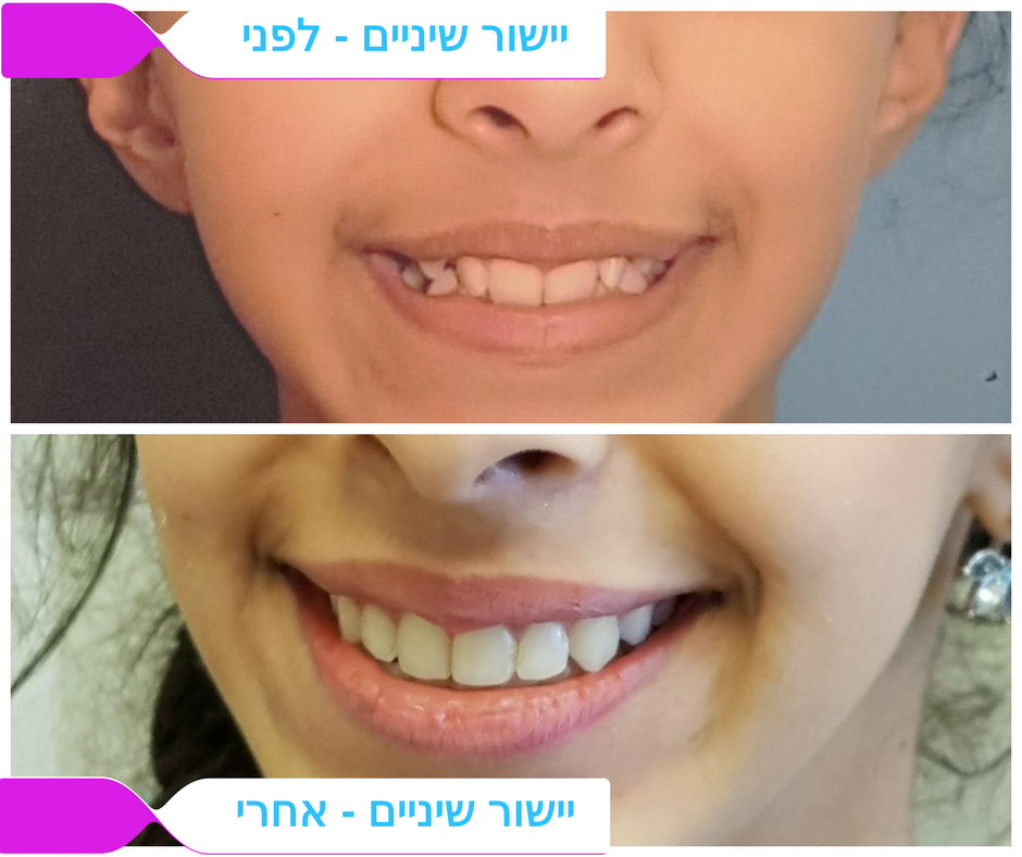 לפני / אחרי יישור שיניים