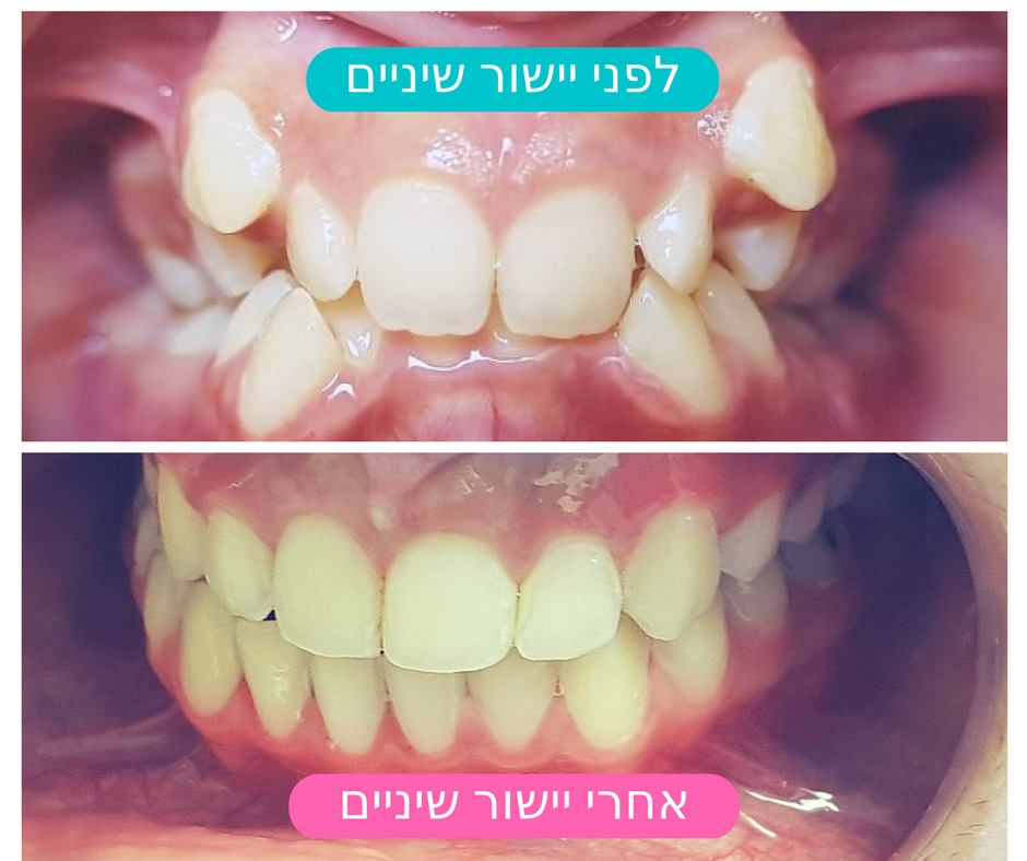 לפני / אחרי יישור שיניים